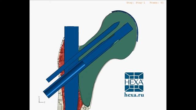 Исследование телескопического болта Targon® PF смотреть онлайн