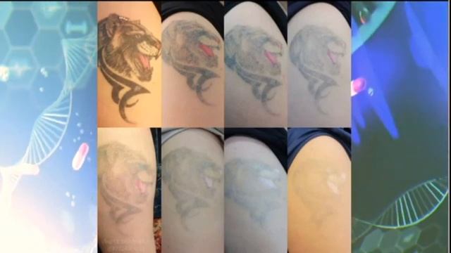 Лазерное удаление татуажа и татуировок на лице и теле смотреть онлайн