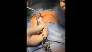 Пластика пупочной грыжи сетчатым имплантом системы "V patch"