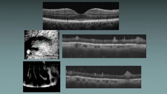 RET06 08 Section III My Best Medical Retina Cases Case Presentation смотреть онлайн