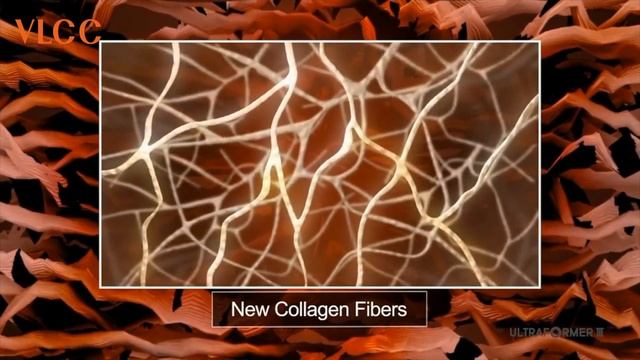 Ultraformer III механизм действия смотреть онлайн