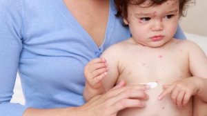 Как проявляется ветрянка у детей симптомы?