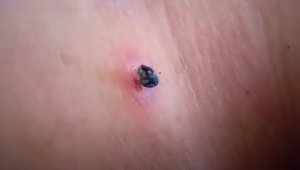 Удаление папилломы чистотелом дома 2