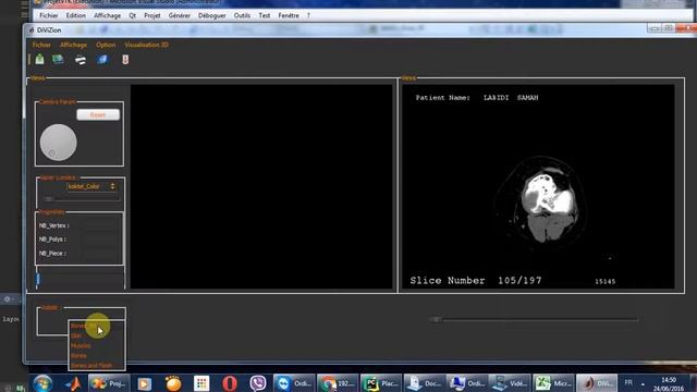 Reconstruction 3D pour images DICOM using VTK смотреть онлайн