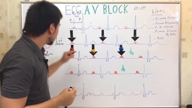 ECG Atrioventricular block (AV block) سلسلة تخطيط القلب الدكتور عبدالله смотреть онлайн