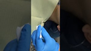 topical EMLA 2.5 Lidocaine / Prilocaine anesthesia placement- for EXT Good