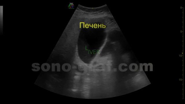 УЗИ - Слизь в желчном пузыре смотреть онлайн