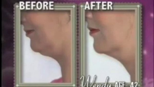 NECKLINE SLIMMER