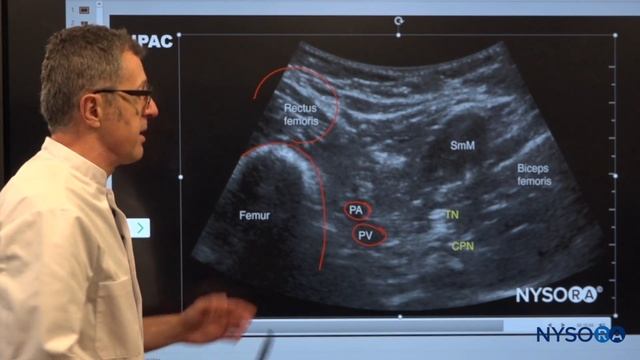 IPACK Block - Regional anesthesia Crash course with Dr. Hadzic смотреть онлайн