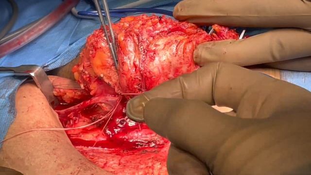 Modified Inguinal Block Dissection смотреть онлайн