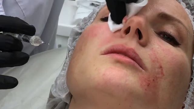 Базовый семинар по контурной пластике с постановкой руки | Анатомия лица смотреть онлайн