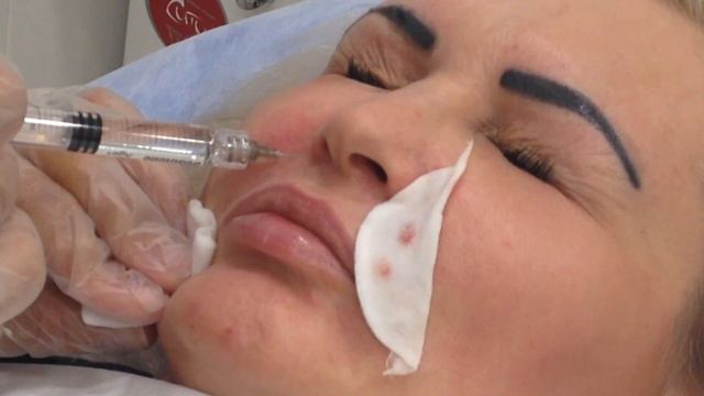 Меди Лайт Применение филлеров Заполнение носогубной складки Техника введения Сэндвич смотреть онлайн