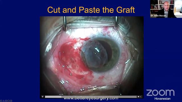 21st Maestro Lecture: John Hovanesian, MD (USA): "Successful Pterygium Surgery" смотреть онлайн