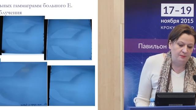 Тотальное облучение при трансплантации костного мозга смотреть онлайн