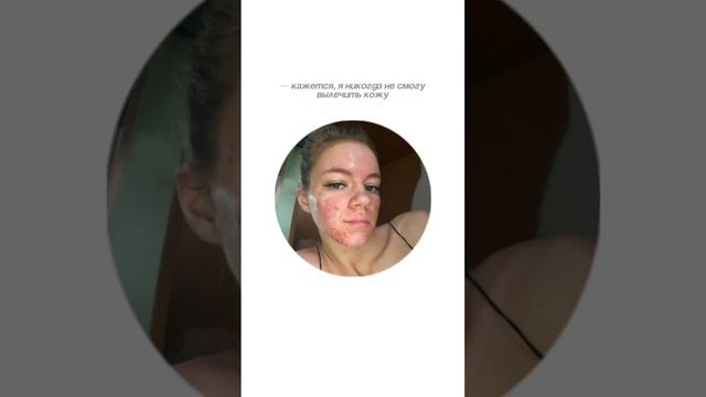 Желаем всем подобрать своего дерматолога, а поддерживающей терапией станет «Гельтек» 😊🙏🏻 #shorts смотреть онлайн