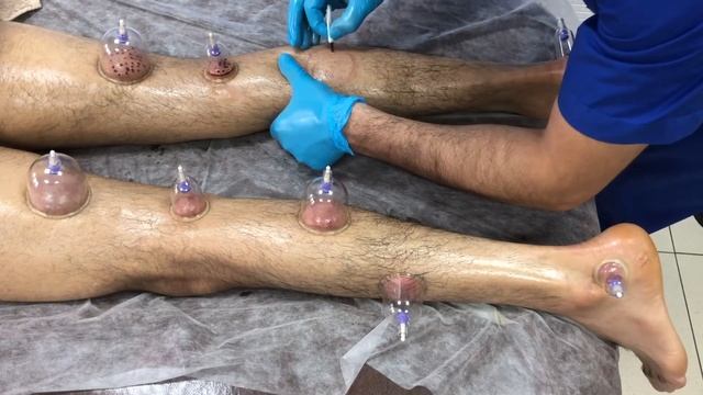 Хиджама на ноги полный обзор