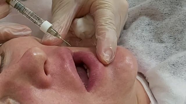 Заполнение носогубной складки и морщин в области рта филлером