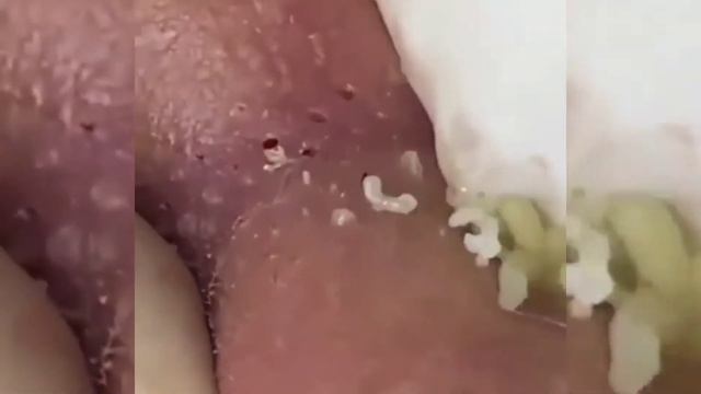 Popping Huge Blackheads And Pimple Popping - Best Pinple Popping Videos #2