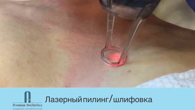 Лазерный пилинг/шлифовка на аппарате AcuPulse.30.10.2018. смотреть онлайн