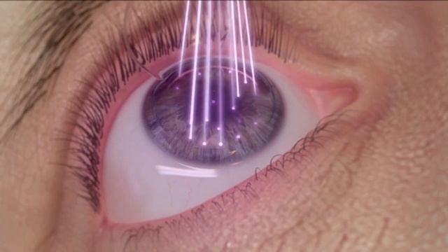 How Precise Is The WaveLight EX500 Excimer Laser смотреть онлайн