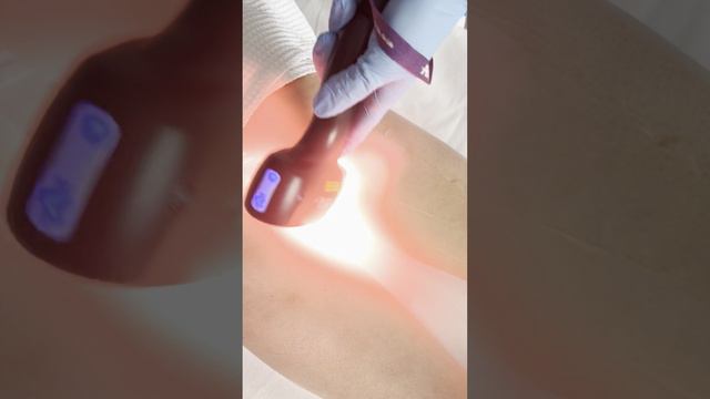 Эпиляция лазером SOPRANO TITANIUM | 3 лазера в одном! | Быстро, без боли и навсегда | клиника GEN87 смотреть онлайн