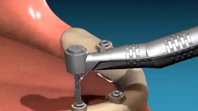 Имплантация зубов В центре Laserstom смотреть онлайн