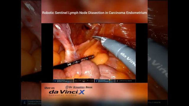 Robotic Sentinel Lymph Node Dissection смотреть онлайн