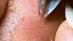 ✅ Чистка пор и выдавливание прыщей #36