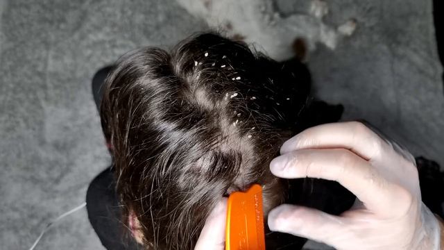 ASMR Lice Removal, NO-Talking! Real Person ASMR, Scalp Check / Lice Check. ?