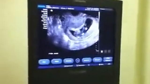 11 weeks pregnancy-baby busy kicking and stretching. смотреть онлайн