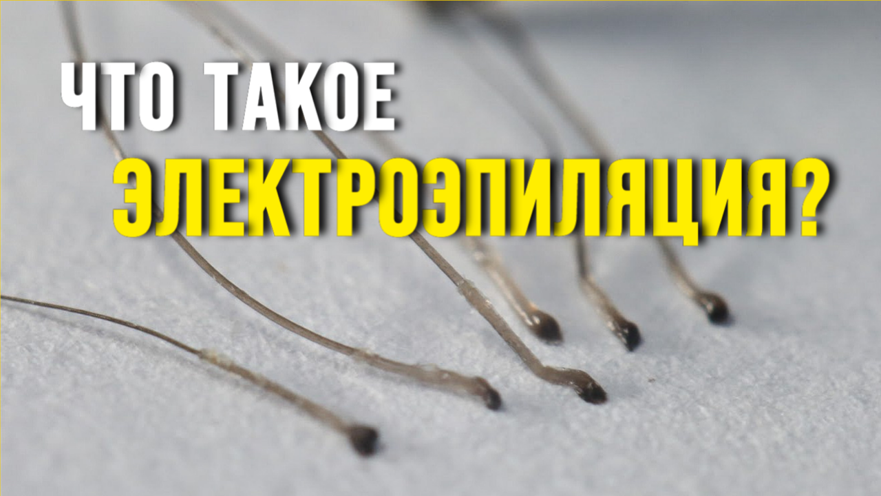 Как удалить волосы гарантированно навсегда? Электроэпиляция смотреть онлайн
