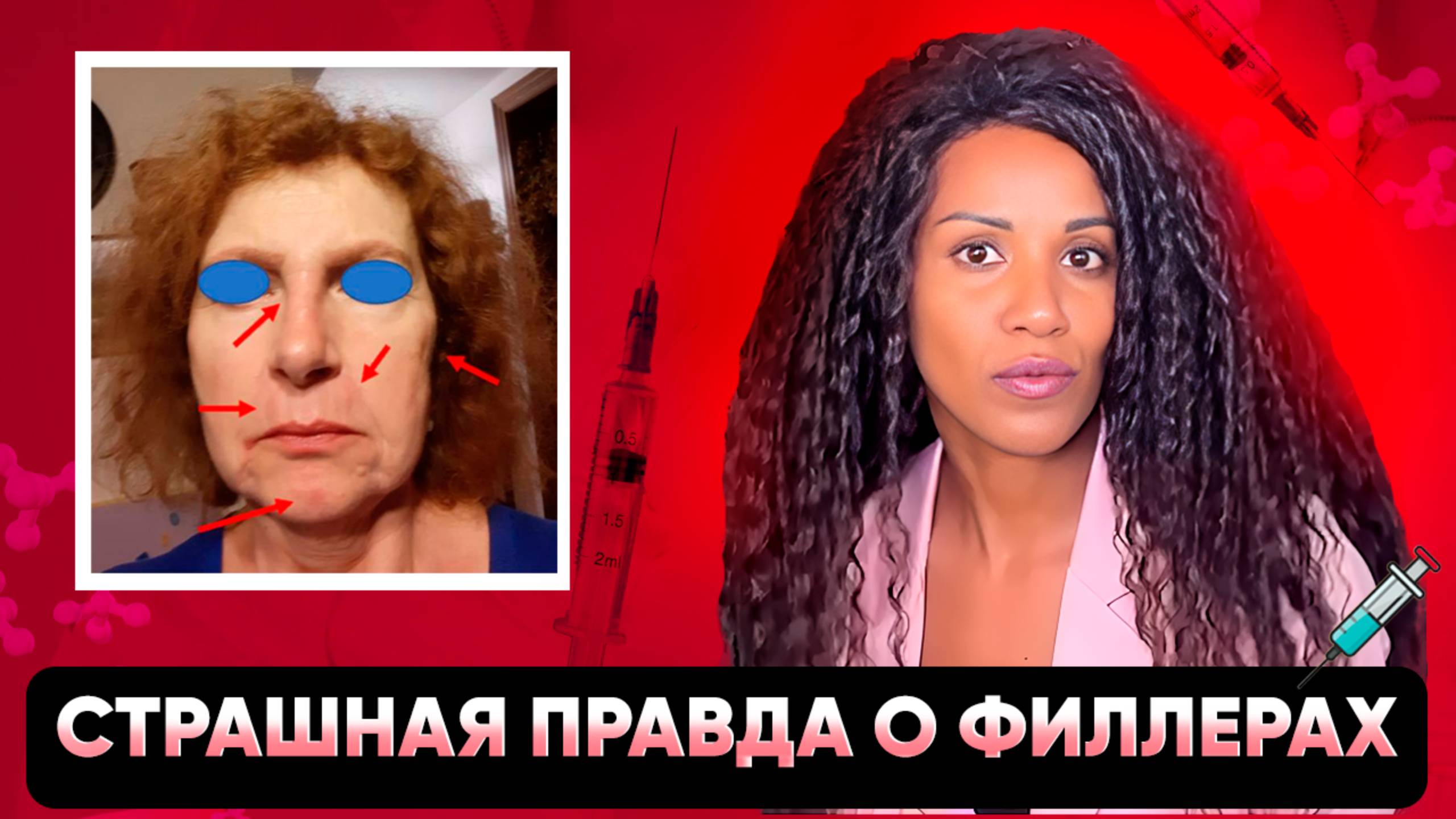 Новое аутоиммунное заболевание, вызываемое филлерами // ASIA-синдром // Чем опасна гиалуронка? смотреть онлайн