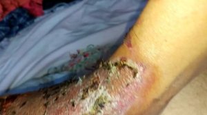 Ожог 4 степень