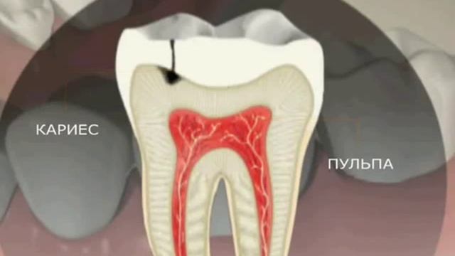 Лечение кариеса Светоотверждаемая пломба смотреть онлайн