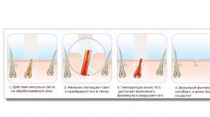 Эпиляция на диодном лазере как воздействует луч основные достоинства и противопоказания