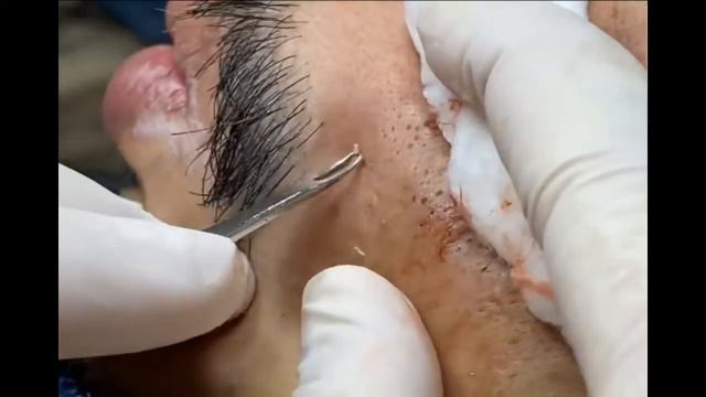 Remoção de cravo 2021 - Pimple Popping 2021- Blackhead Removal 008