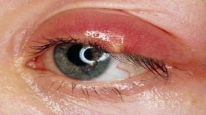 Ячмень на глазу | Простой способ лечения.