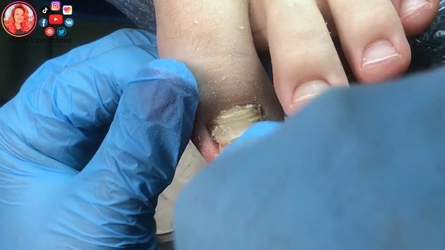 Как подстричь толстые ногти на ногах? / Толстый ноготь на ноге, что делать? смотреть онлайн