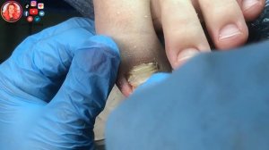 Как подстричь толстые ногти на ногах? / Толстый ноготь на ноге, что делать?