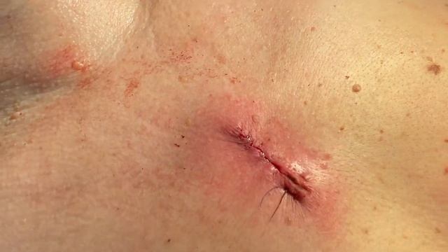 ЖИРовик, удаление и косметический шов смотреть онлайн