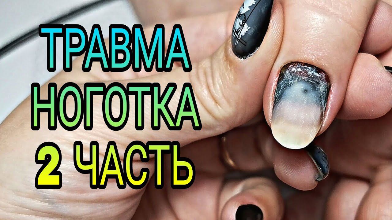 #2 Чёрный ноготок. Носка ногтей в 1,5 месяца ЧРЕВАТА ПОСЛЕДСТВИЯМИ!!! Почему нельзя перенашивать. смотреть онлайн