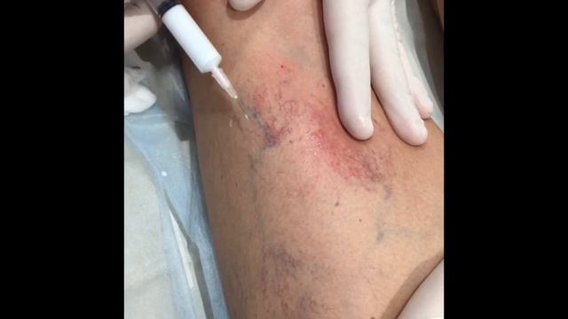 Foam form склеротерапия ретикулярных вен смотреть онлайн