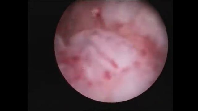 Рак Эндометрия. смотреть онлайн