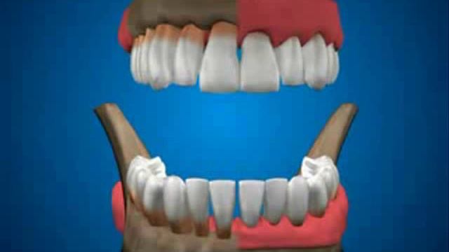 Как выглядит парадонтоз