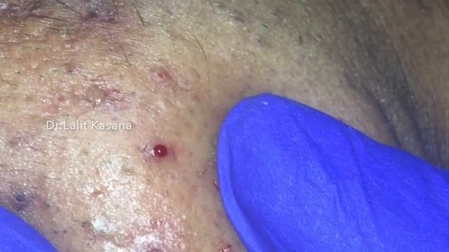 BLACKHEADS PART-2