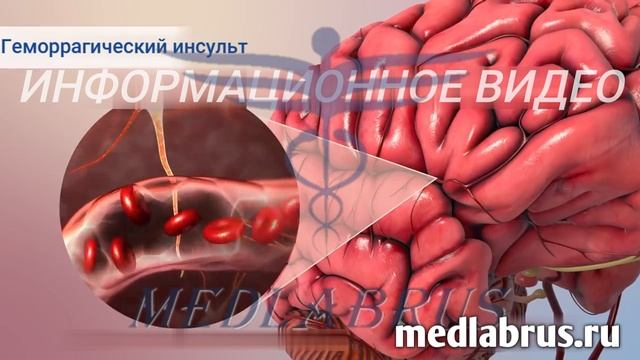 Инсульт-что это такое: основные признаки и профилактика смотреть онлайн