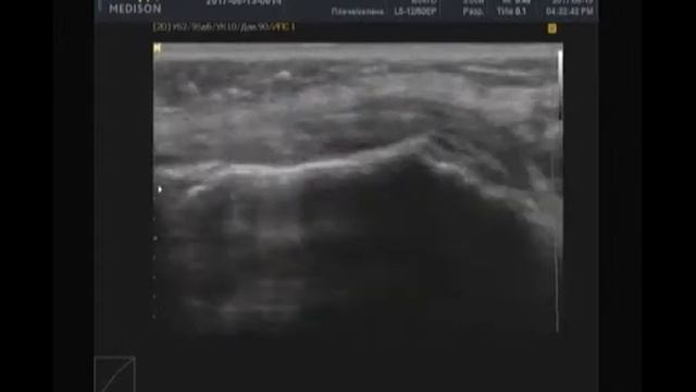 Признаки лигаментита внутренней боковой связки смотреть онлайн