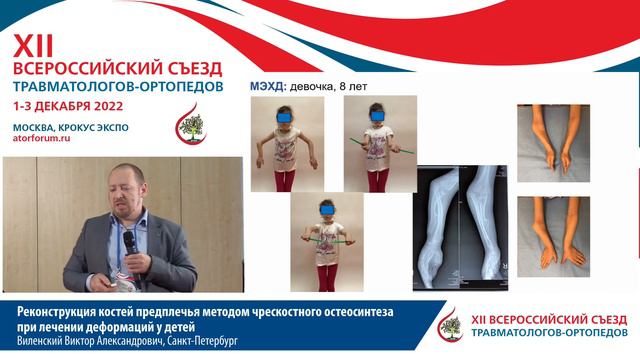 Реконструкция костей предплечья методом чрескостного остеосинтеза при лечении деформаций у детей смотреть онлайн