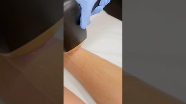 #лазернаяэпиляция#sopranototanium смотреть онлайн