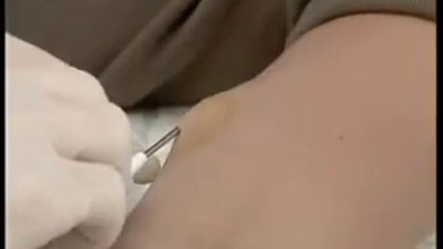 Введение Импланон смотреть онлайн